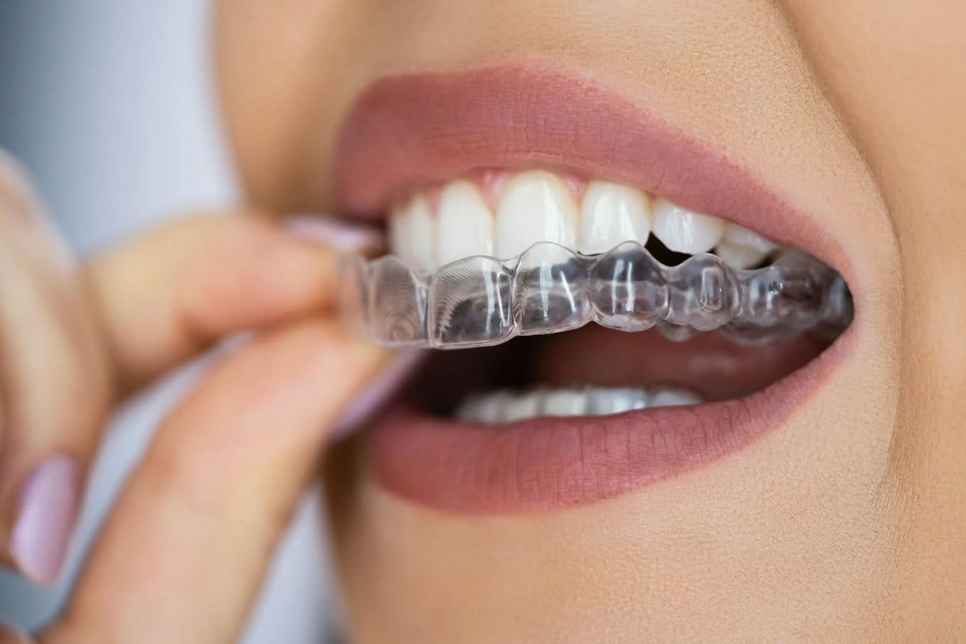 Kiedy można zastosować leczenie Invisalign, a kiedy tradycyjne leczenie ortodontyczne?